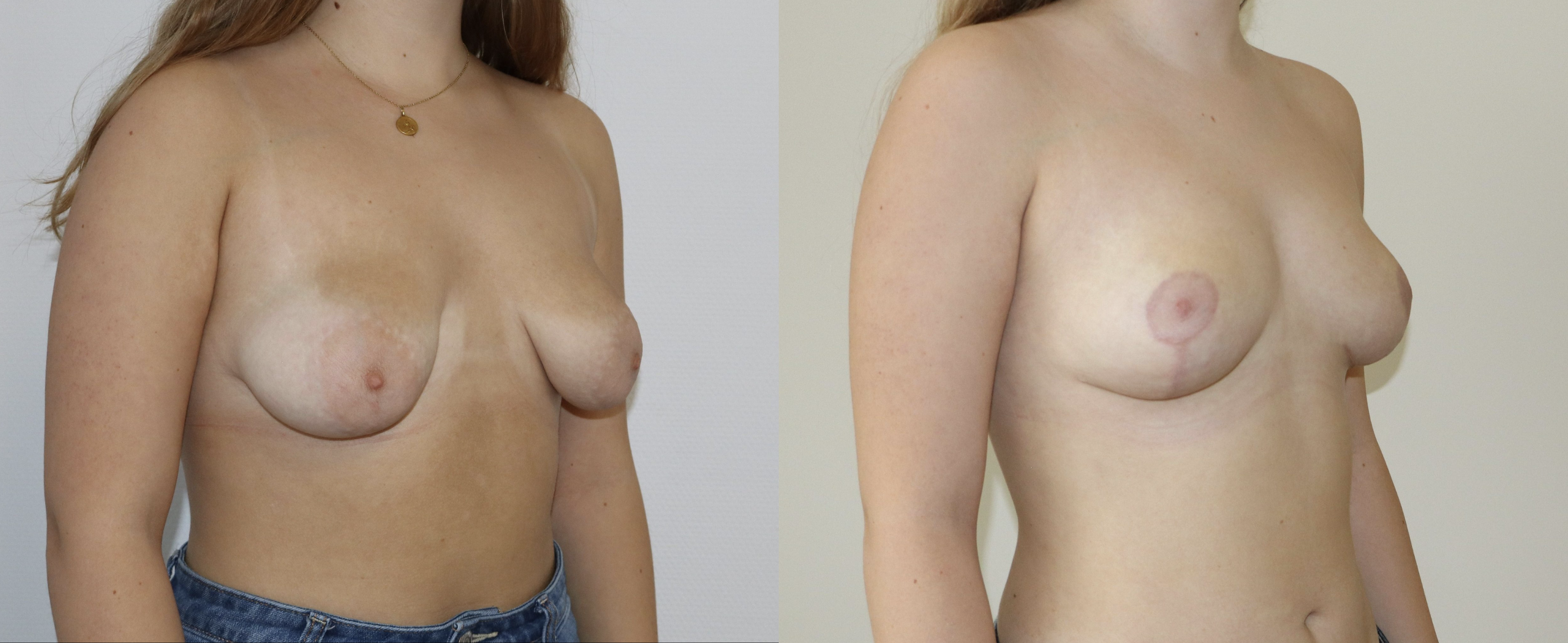 Avant/Après malformation mammaire